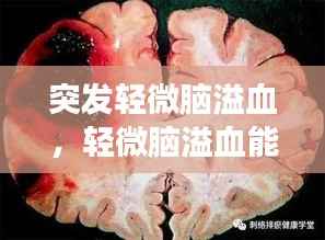 突发轻微脑溢血,轻微脑溢血能自愈吗